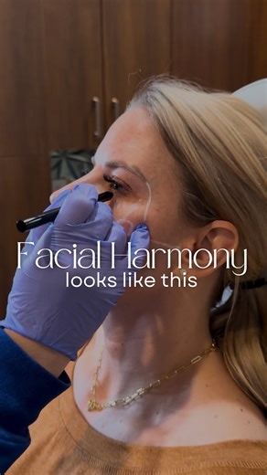 Buckner Aesthetics on Instagram: "Here’s what facial balancing actually is👇 Full facial balancing isn’t about adding volume in one or two places. It’s about assessing the face as a whole and creating harmony between all features. Instead of treating lips or cheeks in isolation, we evaluate how each area works together to support your profile and overall structure. For this client, we strategically enhanced the chin, lips, cheeks, nasolabial folds, and pyriform aperture creating balance and supp