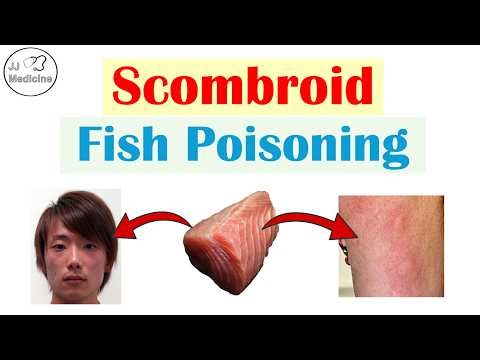 A Hidden Danger in Fish Most People Don’t Know About (Scombroid Fish Poisoning)
