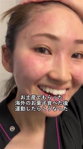 普通に食べても何もならなかったのに運動したら痒くなってきて周りが焦りだして、見たらこれでした🫠アナフィラキシーじゃなくてよかった #閲覧注意 #運動性誘発アレルギー