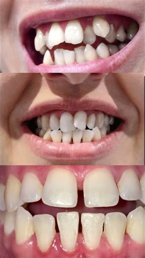 Do I Need Braces? Signs You Need Braces