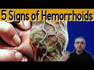 5 Signs of Hemorrhoids: Causes and Treatment