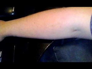 parasites moving under the human skin