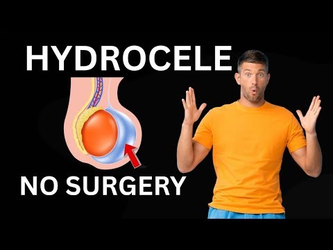Hydrocele Causes Symptoms Treatment | Testies Pain Ka ILaj | Hydrocele No Surgery in Urdu Hindi