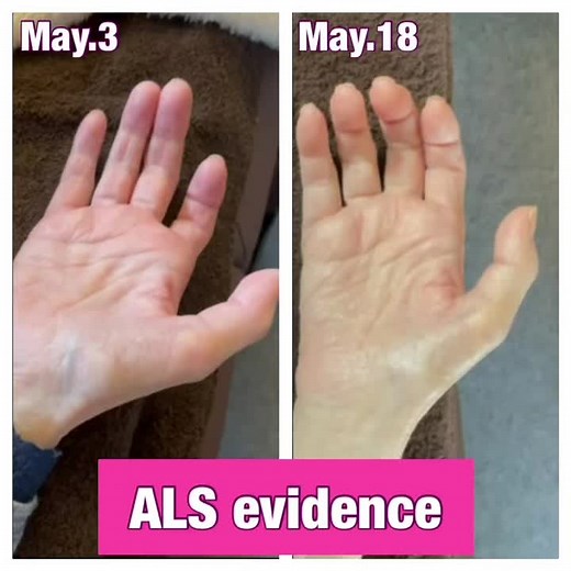 An ALS symptom symptom improvement evidence. She after the treatment she can spread her fingers straighter. ALS can be cured step by step. More great news to come. #als #ela #mortorneurondisease #筋萎縮性側索硬化症