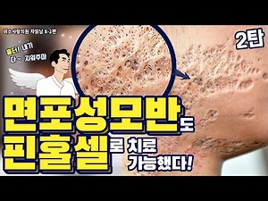 (*Eng)Nevus comedonicus removal laser surgery #2