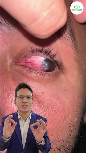 Pterygium Explained: Causes & Treatment by Dr. Shakeel Ahmad | #EyeCare #visioncare