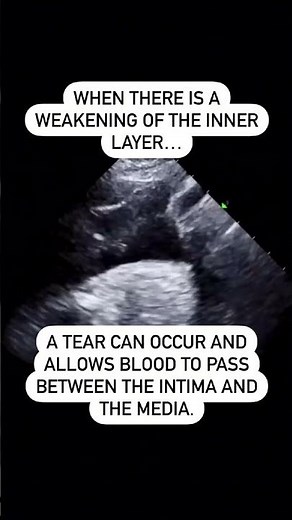 What Is An Aortic Dissection?