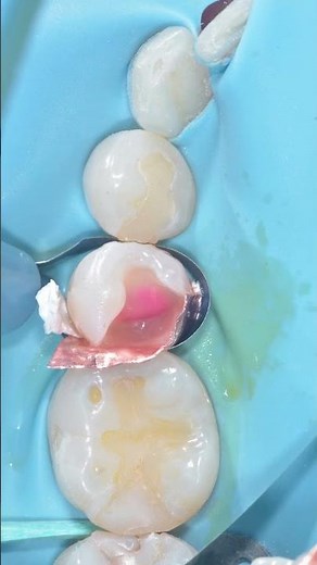 Does Deep Margin Elevation Violate Biologic Width? | Inflammation & DME Explained by Drs. Alleman