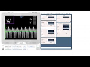 Assessment of Mitral regurgitation by regurgitation Volume and fraction. www.MyEchocardiography.com