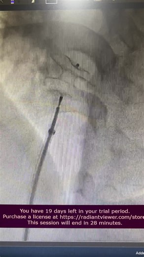 #asddeviceclosure #aakashhealthcare #healthyheartsclinic #drashishagarwal #structuralintervention | Dr Ashish Agarwal