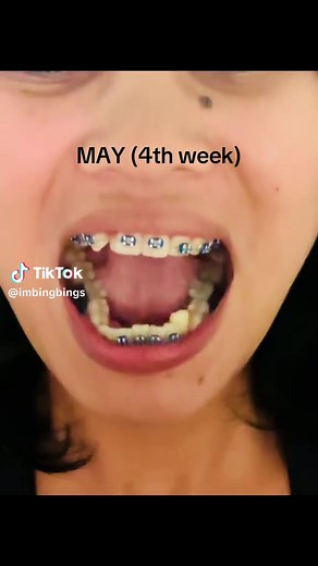 My 11-Month Braces Journey and Upper Teeth Fix