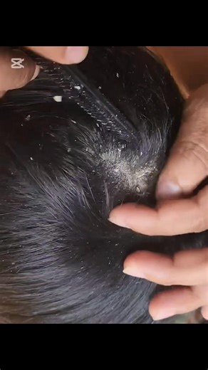 Regular scalp cleaning reduces dandruff ✅ | The Flake Doctor