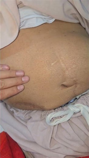 Incisional Hernia After Laparotomy | Surgical Case#IncisionalHernia #Laparotomy #Surgery #MedicalSho