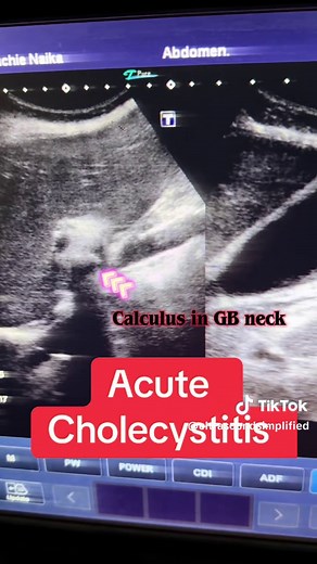 Understanding Acute Cholecystitis and Its Implications