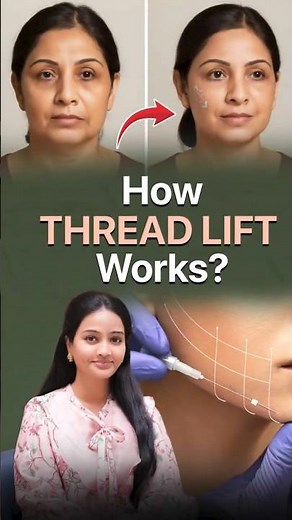 Thread Lift Treatment Explained | Non-Surgical Face Lift & Double Chin Reduction |Dr Aishwarya Reddy
