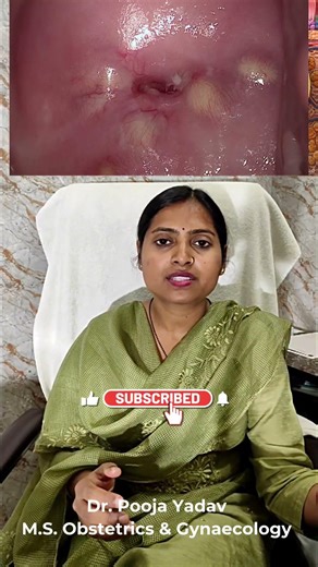 Nabothian cyst explained.