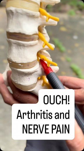 3.1K views · 9 comments | When arthritis develops in the spine, it’s...