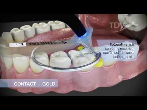 CONTACT + GOLD TDV - Reconstrucción de Puntos de Contacto