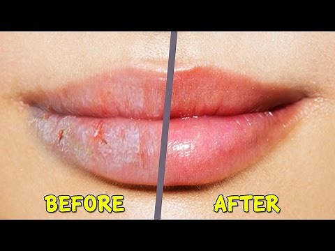 Best home remedies for Dry Cracked Chapped Lips in winter | 100% Work
