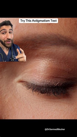 Do You Have an Astigmatism? Find Out Here. Source- PMID 12090633 Astigmatism is a common vision condition caused by an irregular curvature of the eye's cornea or lens. Instead of being perfectly round like a basketball, the eye is shaped more like an oval or a football. This distortion prevents light from focusing sharply onto a single point on the retina, causing images to appear blurred or stretched at all distances. Many people live with mild astigmatism for years without realizing it because