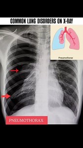 232K views · 1.7K reactions | Common lung disorders on x-Ray.. 贈 #radiology_technique #viralreels #reelsinstagram #medicogirl #mbbsabroad #radiology #xray #reels #radiologist #mbbs #mbbsstudent #radiologia #LungHealth #PulmonaryCare #pulmonology #pulmonologist | Diwakar Patel | Facebook