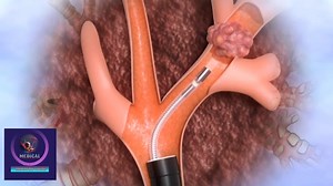 Lung Biopsy Procedure | Diagnose of Lung Disease | #LungBiopsy #LungHealth #MedicalProcedure #LungDiseaseDiagnosis #BiopsyProcedure #PulmonaryHealth #LungCancerScreening #NeedleBiopsy #Bronchoscopy #ThoracicSurgery #LungCare #RespiratoryHealth #HealthDiagnosis #MedicalExplained #LungTreatment | Medical Animation Media