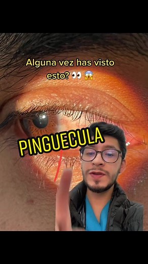 Pinguecula: causas y tratamientos efectivos