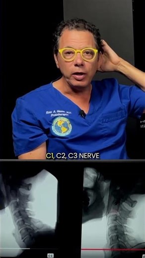 Correcting the neck curve can improve migraine headaches and trigeminal nerve dysfunction #neuralgia