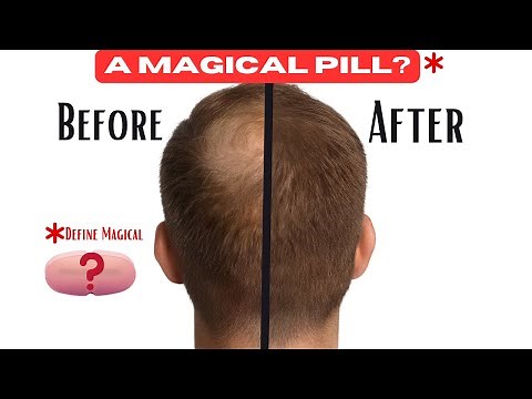 Finasteride: The Good, Bad and The Ugly of The Best Option To Keep Your Hair