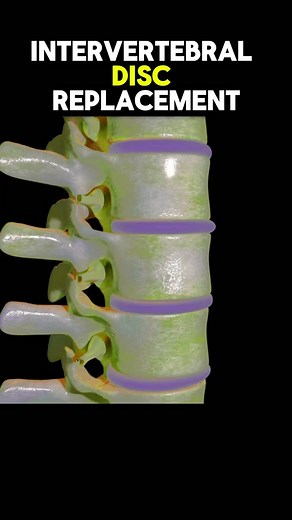 Intervertebral Disc Replacement 3D Animation procedure #discreplacement #disc #surgery #animation #discreplacementsurgery #intervertebraldisc #medical #backbone #learnwithtiktok #education #medicalanimation