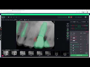 Dentrix Ascend Auto Charting Detect Denti AI