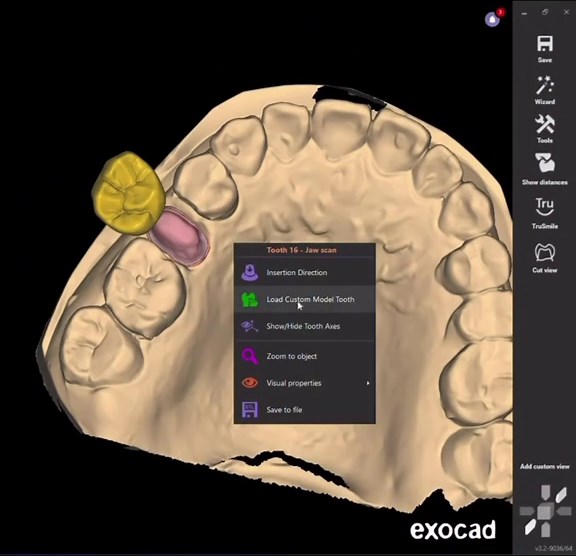 Exocad Tips and Tricks for Dental Professionals