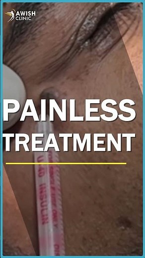 Gentle and Safe Mole Removal Near the Eye: Your Guide to Flawless Skin | AWISH Clinic