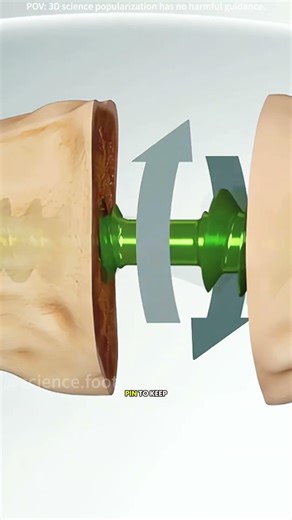 How hammer toe surgery is performed (3D animation) #footsurgery #anklefusion #tibial #footankle