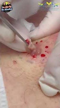 IYKYK- Abscess 🌋 Welcome to the, “Cyst Show” 🎥 🍿with Dr. Vegas H.L. Greenberg, M.D.