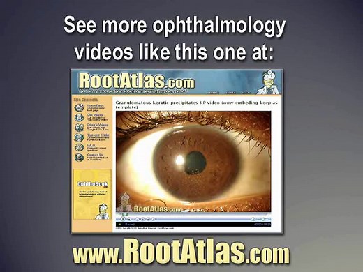 Elschnig pearl formation (Video) - TimRoot.com