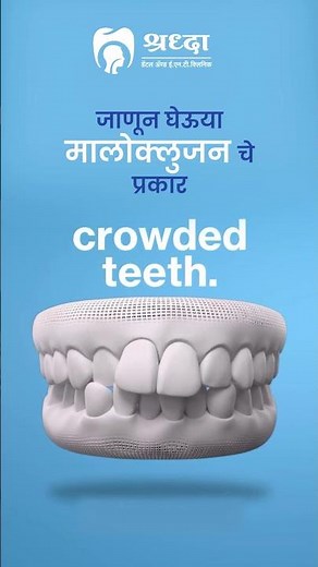 Types of Malocclusion Explained | Common Dental Problems You Shouldn’t Ignore