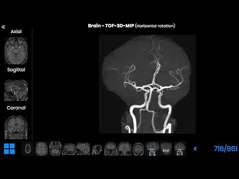 Radiologic anatomy of the circle of Willis (cerebral arterial circle)