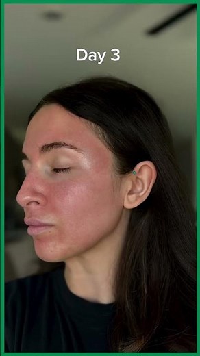 BBL + MOXI + NanoLaserPeel Recovery (Day by Day)