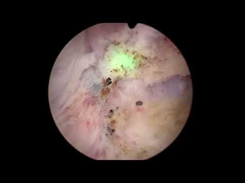 HOLEP 2025 CASE 54 - 50gr - 35mins - High Power HoLEP