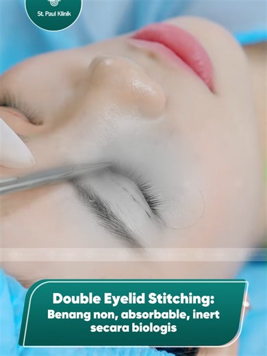 TAKUT HASIL TERLIHAT “BUATAN”? TAKUT TERLIHAT JEJAK TINDAKAN ESTETIKA? Di ST. PAUL: ✅ Tanpa sayatan ✅ Tanpa pengangkatan jaringan ✅ Tanpa bekas luka Hanya 30–45 menit: ✨ Lipatan mata terlihat alami ✨ Tidak terlalu tinggi ✨ Tidak kaku ✨ Tanpa tanda tindakan yang terlihat jelas Perubahan yang cukup membuat Anda lebih menarik — tanpa menghilangkan karakter alami Anda. 👉 INBOX SEKARANG untuk konsultasi struktur kelopak mata & reservasi langsung. ———————— 📞Hotline: 0812-4104-9362 🌙 Open hour: 9AM-