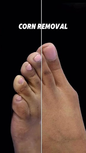 💉Treatment Minimally Invasive Corn Removal Surgery 🎯Purpose Alleviate pain and discomfort