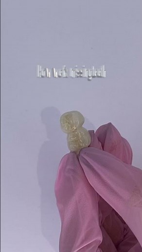 How to fix a missing tooth with a dental bridge - Oakville Dentist