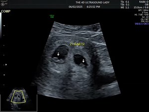 10K views · 293 reactions | 6 week 4 day old twins 殺 | The 4D Ultrasound Lady | Facebook