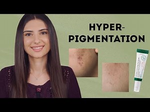 Σημάδια από σπυράκια και πως να τα αντιμετωπίσεις | Olga