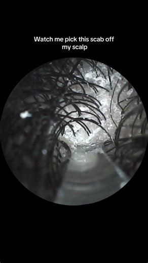 Effective Solutions for Psoriasis, Scabs, and Dry Scalp Issues