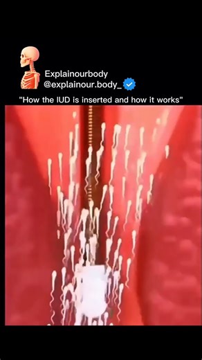 Explainourbody on Instagram: "😳 THIS is how an IUD is inserted — and how it prevents pregnancy It may look uncomfortable… but it’s one of the most effective birth control methods available 👇 🔹 The IUD is gently placed inside the uterus 🔹 Copper or hormones change the uterine environment 🔹 Sperm movement is blocked 🔹 Fertilization becomes nearly impossible ⚕️ No daily pills ⏳ Works for 3–10 years 📉 Over 99% effective This is medical science, not fear — and millions of women use it safely w