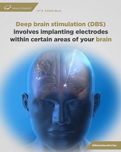 Deep brain stimulation (DBS) is a minimally invasive procedure where a device is implanted in the brain sends electrical signals to the areas responsible for body movement. Electrodes placed deep inside the brain are connected to a stimulator which movement disorders when symptoms of diseases like Parkinson’s worsen. Deep brain stimulation (DBS) is now possible in Singapore. Drop us a message here or contact our colleagues at the Mount Elizabeth regional offices in Dhaka, Chattogram or Sylhet fo