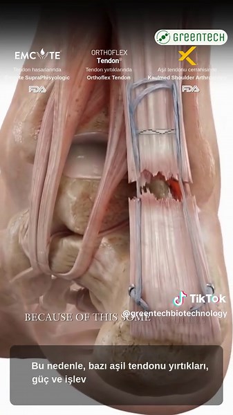 Aşil Tendonu, ayak bileğinin arkasında bulunan kalın ve güçlü bir tendondur. Ayağın aşağı doğru itilmesine ve vücudun ileriye doğru hareket etmesine yardımcı olur. Baldır kasları ve ayak ile ayak bileğindeki diğer yapılarla birlikte çalışır. Bu durum, aktivite sırasında hareketin, gücün ve dengenin korunmasına yardımcı olur. Aşil tendonu yaralanmaları, özellikle aktif bireyler ve sporcular arasında çok yaygındır. Bu yaralanmalar, tendon aniden çok fazla strese maruz kaldığında meydana gelir. Aşi