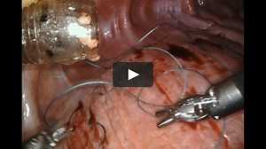 Robotic Thoracic Surgery - Robotic Right Diaphragm Plication